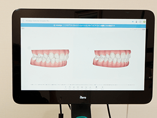3D光学スキャナーを使用して口の型取りをしている画像